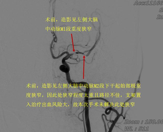硬核！这家医院接连开展两例四级高难度脑血管介入手术