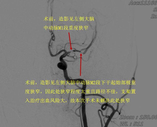 硬核！这家医院接连开展两例四级高难度脑血管介入手术