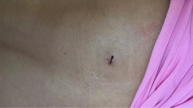 30 分钟手术、1 天下地行走，烟台海港骨外一科微创手术解除病痛