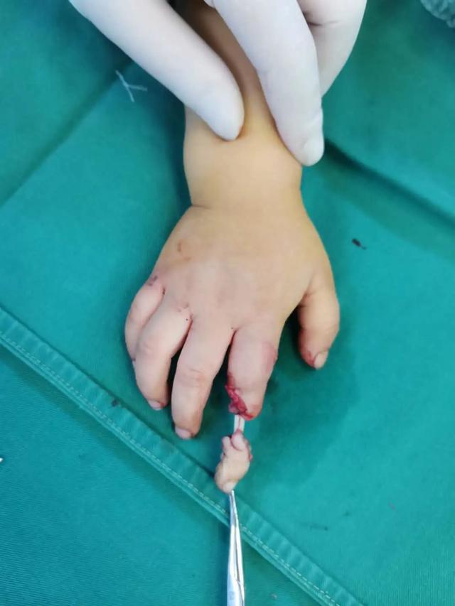 3 岁儿童食指离断，7 小时后遇到「对的人」