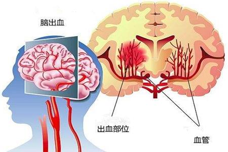 高血压患者预防脑出血，除了烟酒，还有5个直接诱因，及时避免