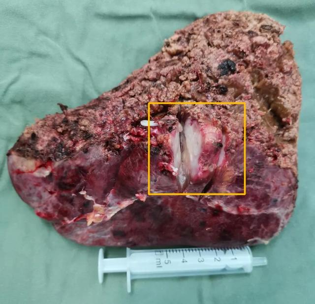 树兰（杭州）医院肝胆胰外科  成功完成一例腹腔镜右半肝切除术