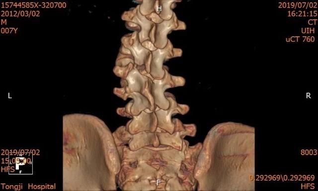 同济大学附属同济医院成功救治一例复杂儿童腰椎半椎体畸形