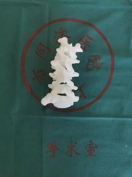 同济大学附属同济医院成功救治一例复杂儿童腰椎半椎体畸形