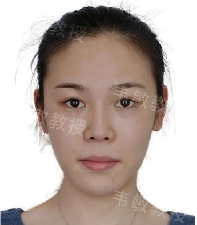 兩次整形手術讓他成功實現男變女