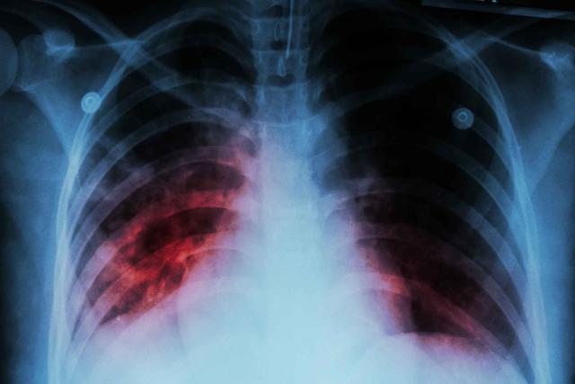 肺炎的X线表现与CT表现，有什么不同？详细分析给你看