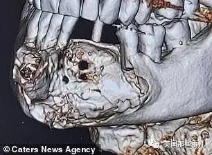 英国大叔27年没去看过牙医，再去时竟要切掉90%下颌