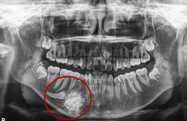 组合性牙瘤图片