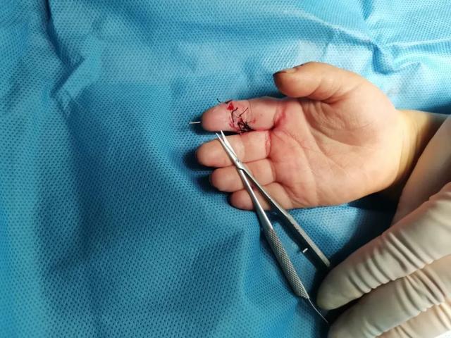 3 岁儿童食指离断，7 小时后遇到「对的人」