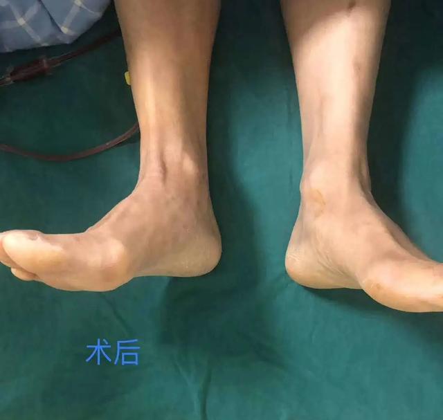 患者右腿比左腿短了7公分，全髋置换+截骨拼合手术如何展开？