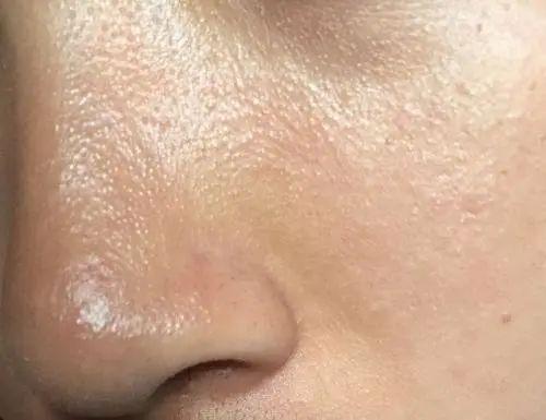 震惊！皮肤科门诊爆号了：空调下皮肤伤不起，水和油都离家出走了