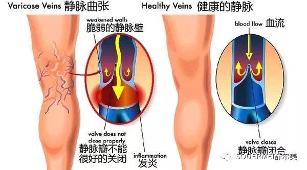 静脉曲张患者生活中要多注意这些细节，避免加重的可能性(图1)