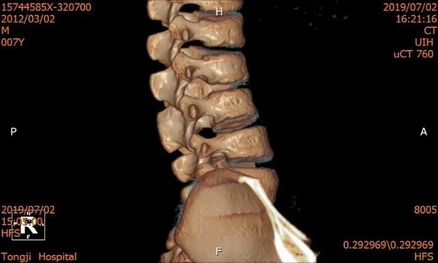 同济大学附属同济医院成功救治一例复杂儿童腰椎半椎体畸形