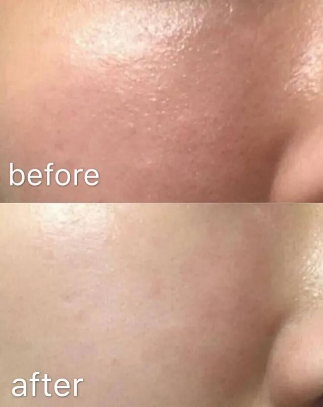 口罩下痘痘频频冒出？唯诺雅来拯救来自“痘星”的你