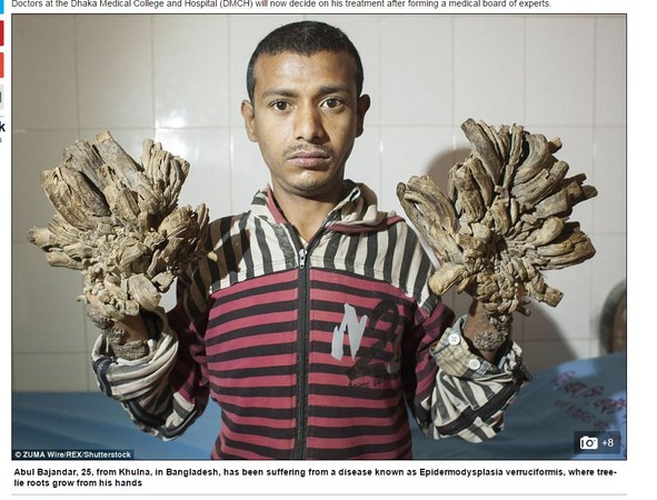 手脚长出“树皮和树根”，孟加拉男子得怪病变“树人”