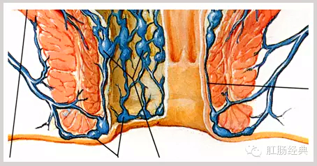 百变痔疮，图说本质