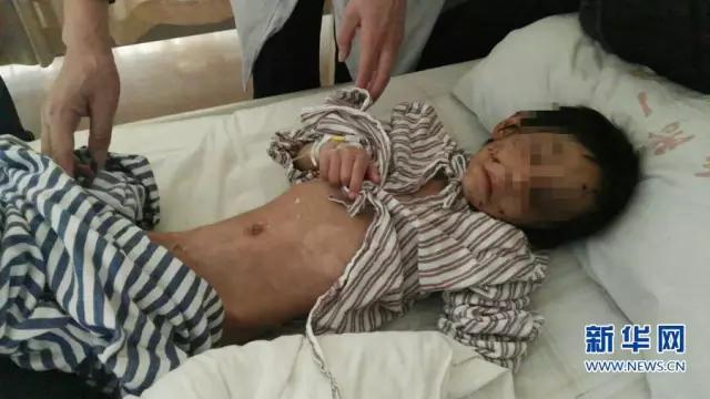 5岁女孩福州校外托管被虐待浑身是伤！看到图心都碎了！