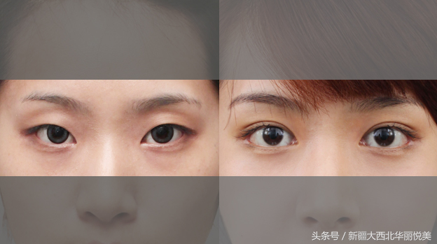 所谓的韩式双眼皮术到底是什么？