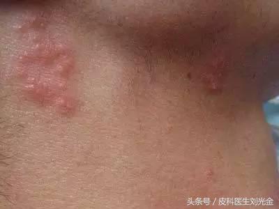 皰疹最佳治療方法（女性生殖皰疹最佳治療方法）