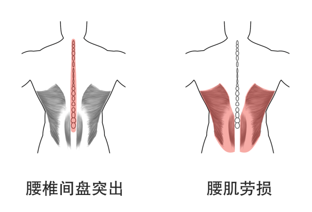 腰椎间盘突出的这些治疗方法，必须安利给大家