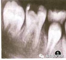 儿童恒牙根管治疗中出现皮下气肿一例