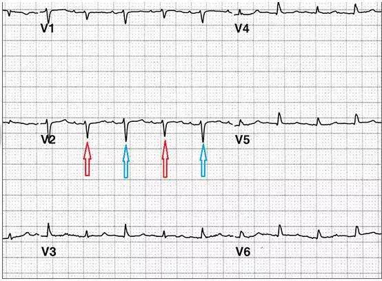 警惕!6种可能致命的心电图异常不容忽视!