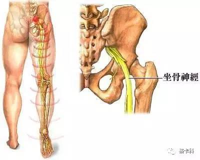 腰椎间盘突出的症状怎么缓解（腰椎间盘突出的症状）