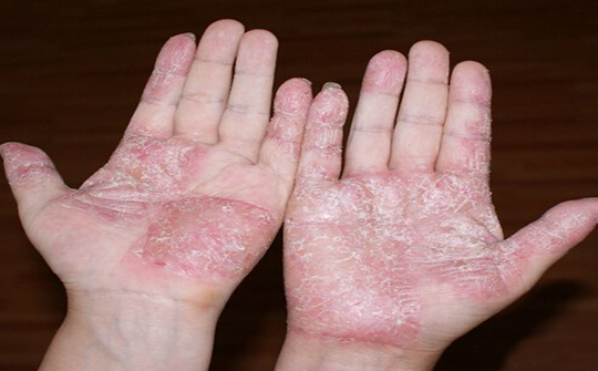 手真菌感染症状图片