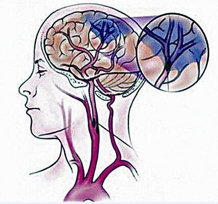 做好这6点，可预防颈动脉堵塞