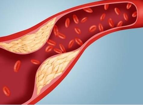 做好这6点，可预防颈动脉堵塞