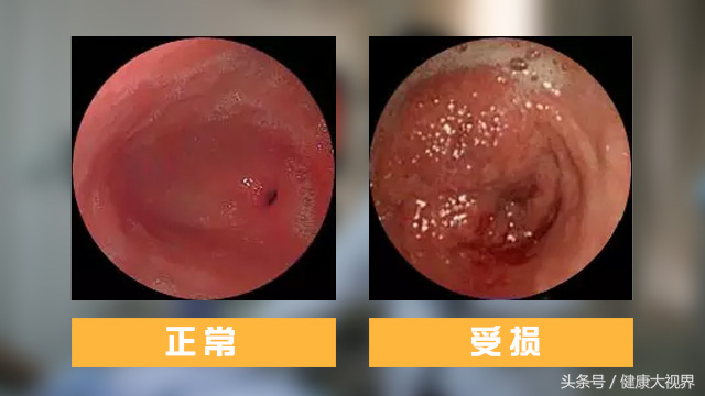 萎縮性胃炎的癥狀表現有哪些（慢性萎縮性胃炎的癥狀表現有哪些）