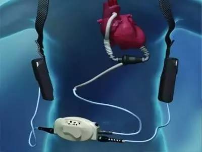 面对心脏病不再绝望？机械心脏泵助患者恢复健康！