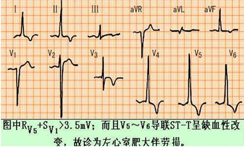 临床常见异常心电图识别