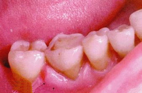 注意了！口腔溃疡极有可能恶化成口腔癌，你会辨别吗？