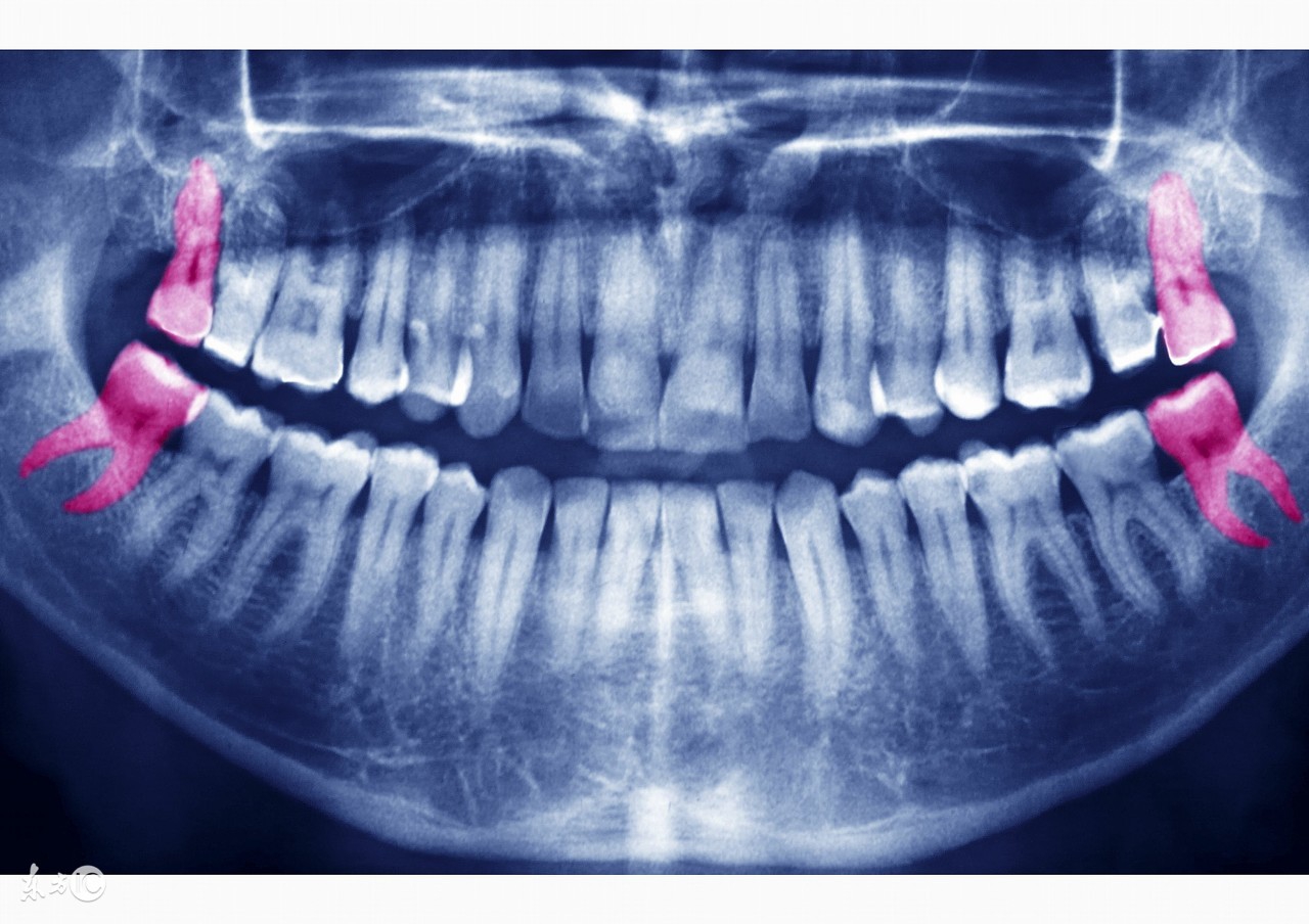 智齿并不是人人都要拔，这些人拔牙可能有生命危险！