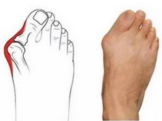 大脚趾外翻的预防和治疗方法有？