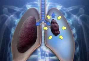 5种常见呼吸道疾病的临床表现及防治方法，值得收藏！