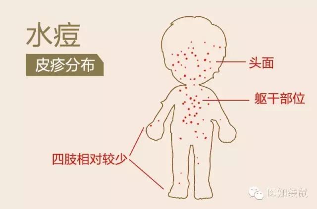 水痘、手足口病、麻疹、风疹，这些传染病你能分得清么？