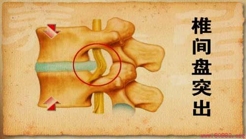老年人怎样预防腰椎间盘突出症?