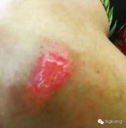 BIGBANGTOP在德国拍摄受伤了？！ 满满留下草莓伤疤
