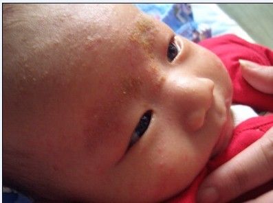 宝宝患有湿疹或苔藓，不要惊慌，要这样做才最好