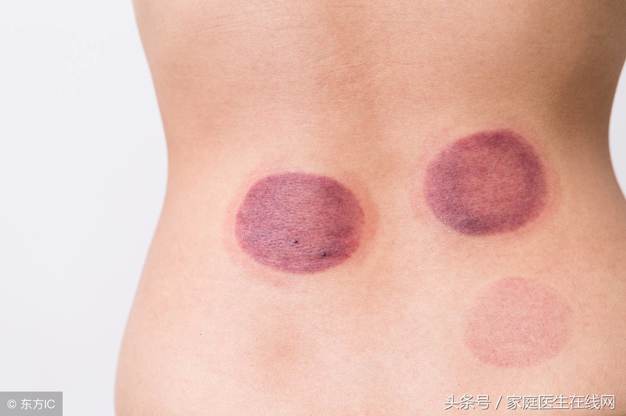 拔罐颜色代表什么问题这4种颜色暗示着不同问题快对照看看