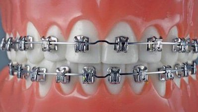 牙齿矫正的好 八颗牙微笑不是问题