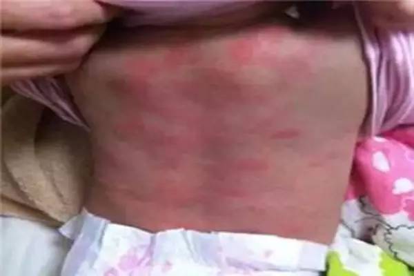 这个外国妈妈为湿疹3年的女儿绝望时，中国的一条小偏方救了她