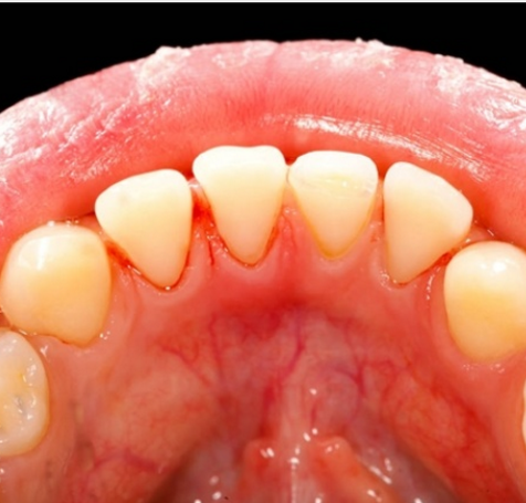 牙龈出血的原因有哪些