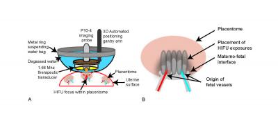 Sci Transl Med:超声波成为胎盘疾病中阻断缺陷血管的工具