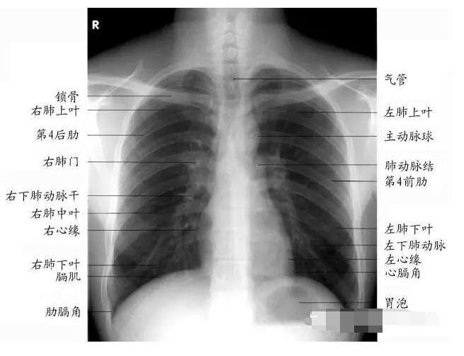 胸片的读片方法及技巧总结