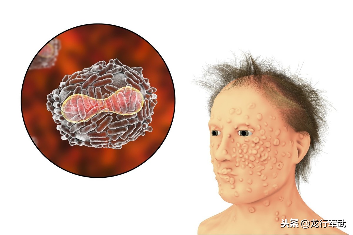 在西方世界肆虐近万年的天花，为何在我国没有掀起“大风大浪”？