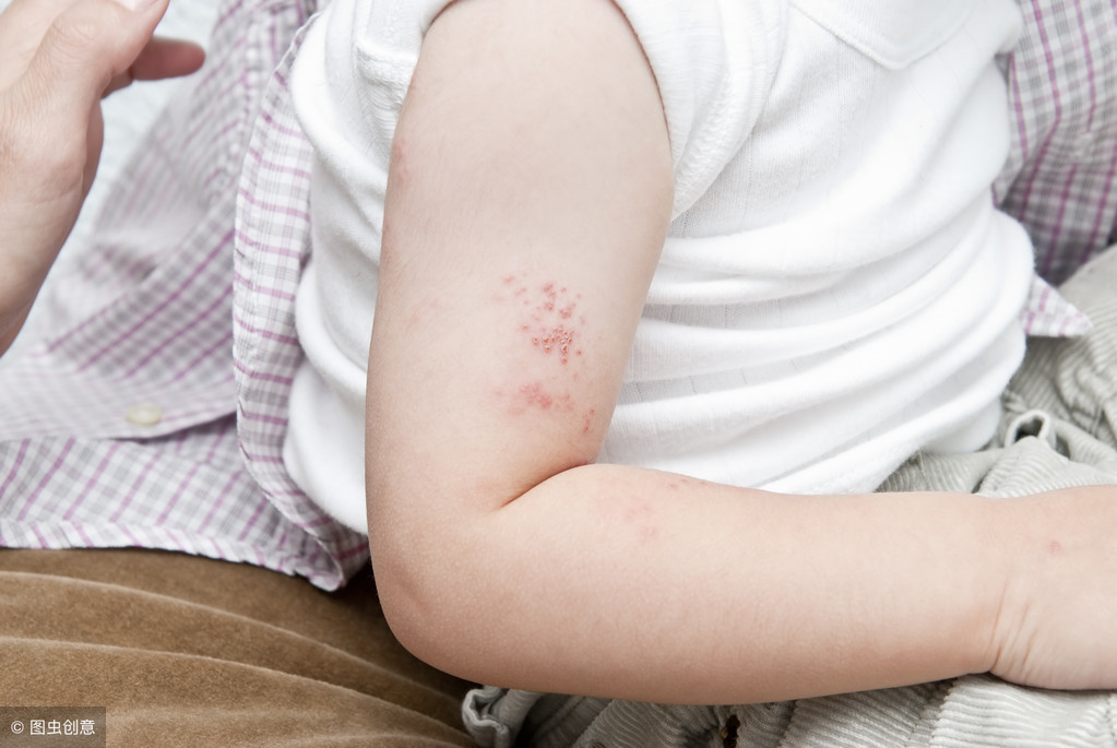日常该如何预防水痘？这4个小妙招，或能助你一臂之力