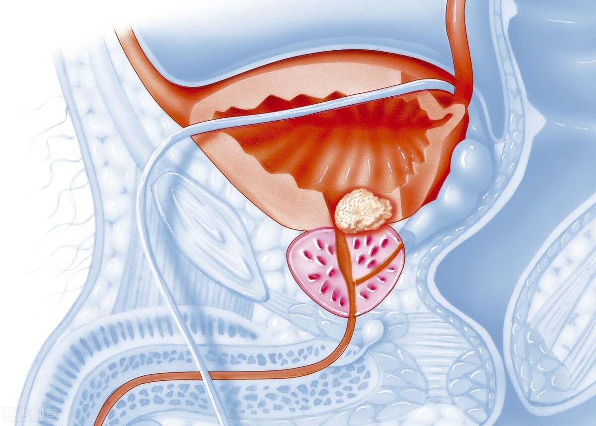 慢性列腺炎到底是不是造成功能障碍的根源？